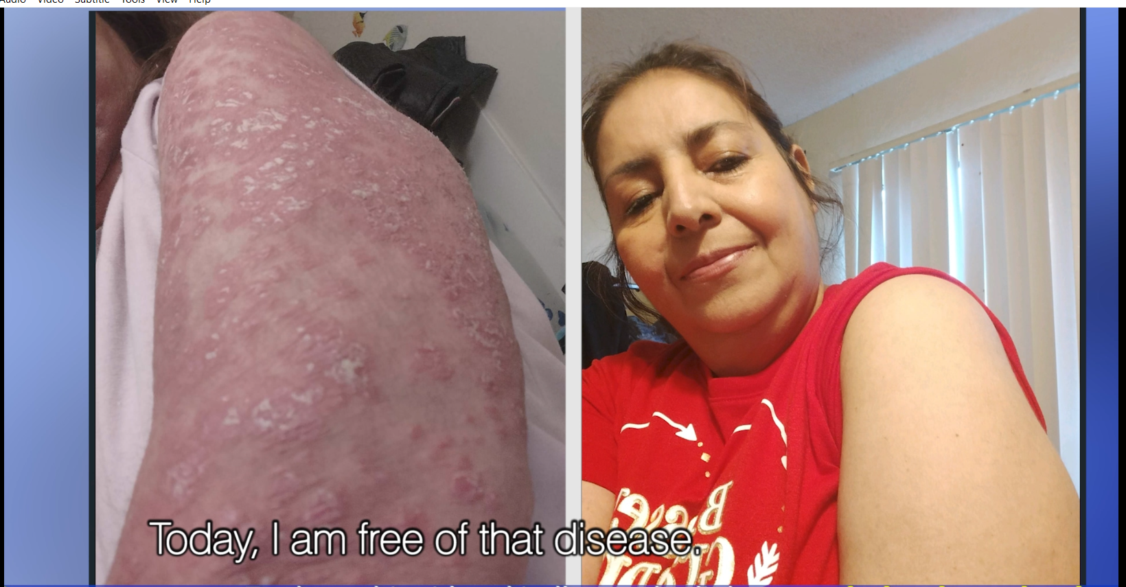 PSORIASIS DEFEATED: ESTELLA'S MIRACLE